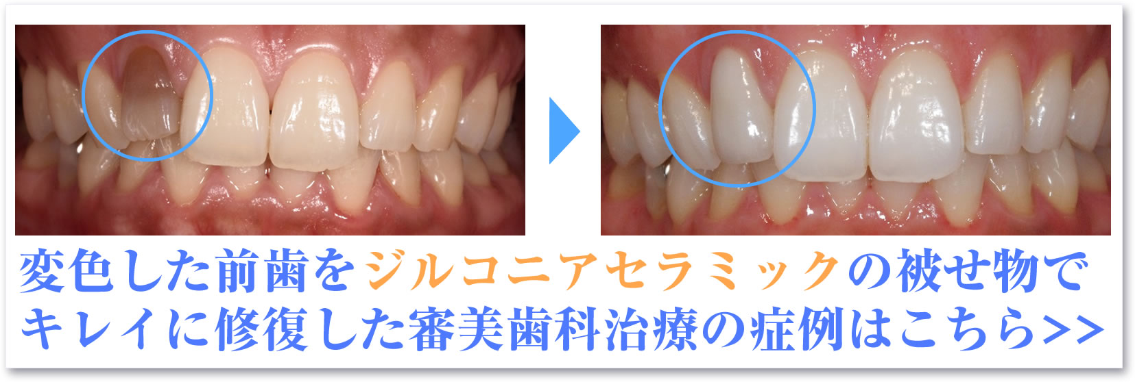 変色した前歯をジルコニアセラミックの被せ物で キレイに修復した審美歯科治療の症例はこちら>>