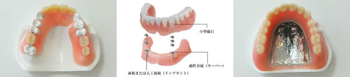 入れ歯