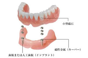 磁性マグネットデンチャー