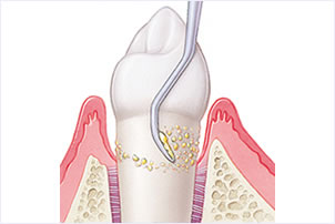 歯周病治療にこだわる