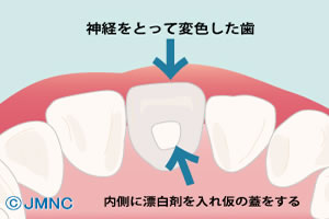 ホームホワイトニング