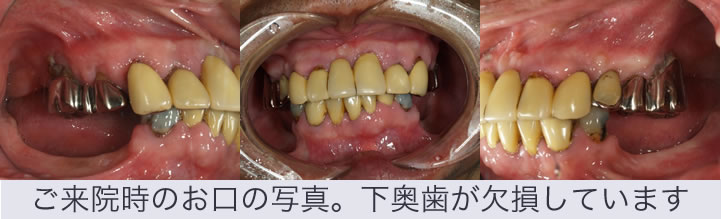 オールオン4 インプラント の症例 専門医執刀 埼玉県羽生市の木村歯科医院