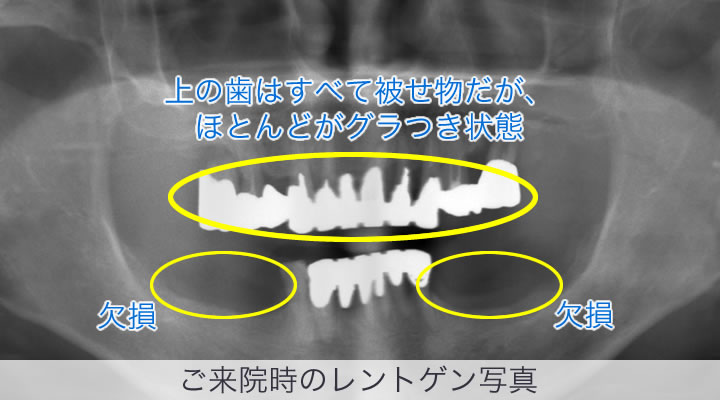 オールオン4 インプラント の症例 専門医執刀 埼玉県羽生市の木村歯科医院