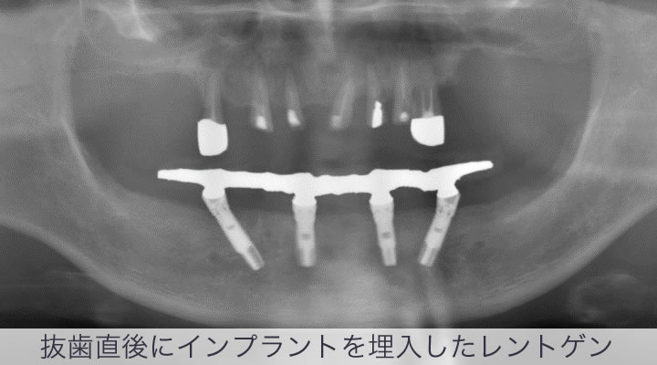 オールオン4 インプラント の症例 専門医執刀 埼玉県羽生市の木村歯科医院