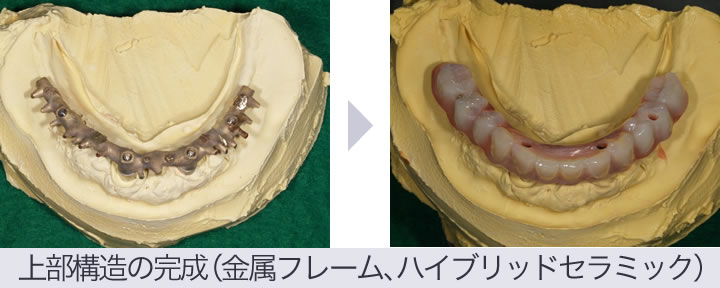 オールオン4インプラントの仮歯