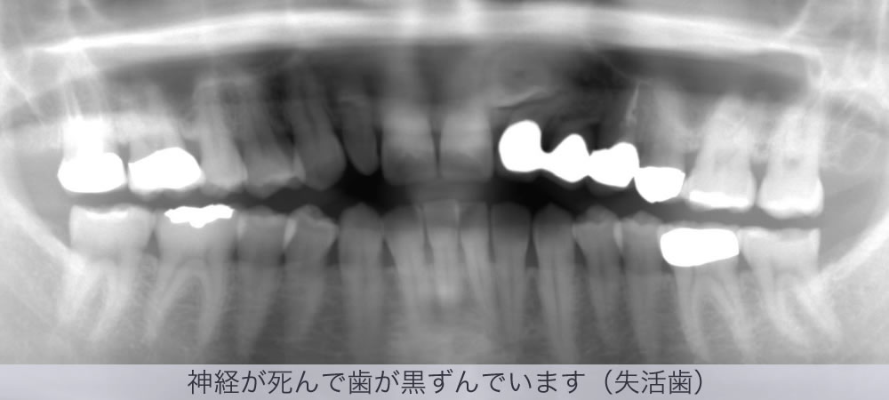 神経が死んで歯が黒ずんでいます（失活歯）