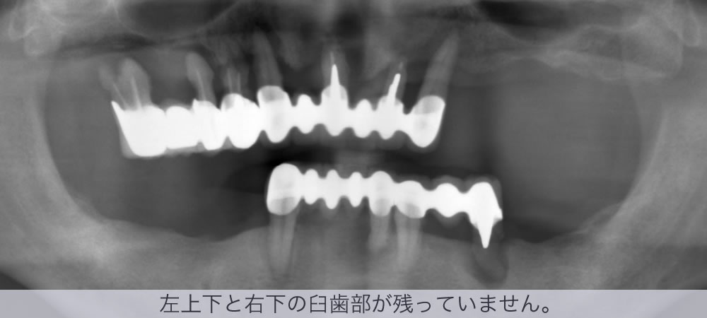 左上下と右下の臼歯部が残っていません。