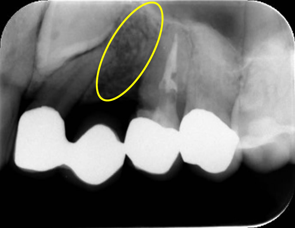 前歯のインプラント治療