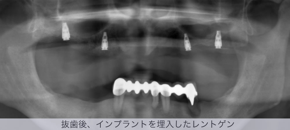 抜歯後、インプラントを埋入したレントゲン