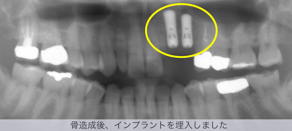 骨造成後、インプラントを埋入しました