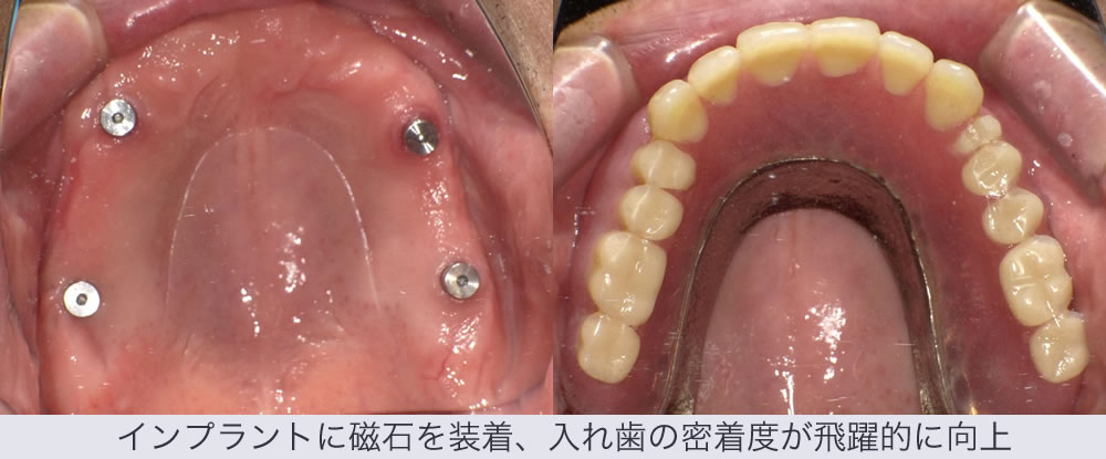 インプラントに磁石を装着、入れ歯の密着度が飛躍的に向上