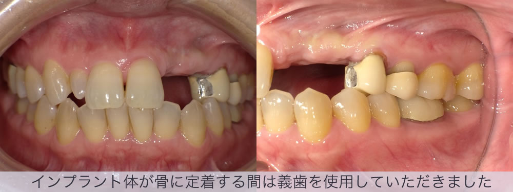 インプラント体が骨に定着する間は義歯を使用していただきました