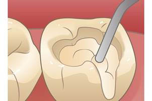レジン充填による虫歯治療