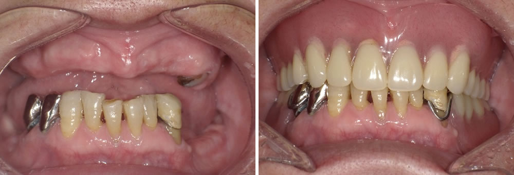 金属床総義歯