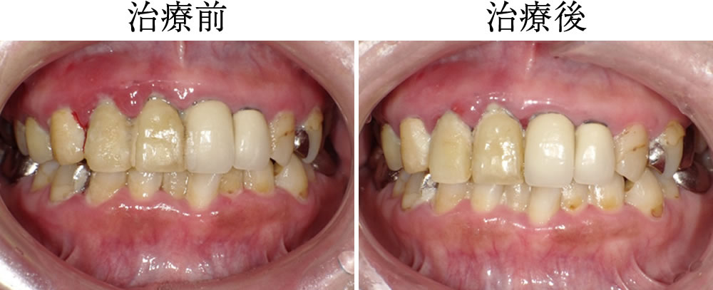 歯周病症例