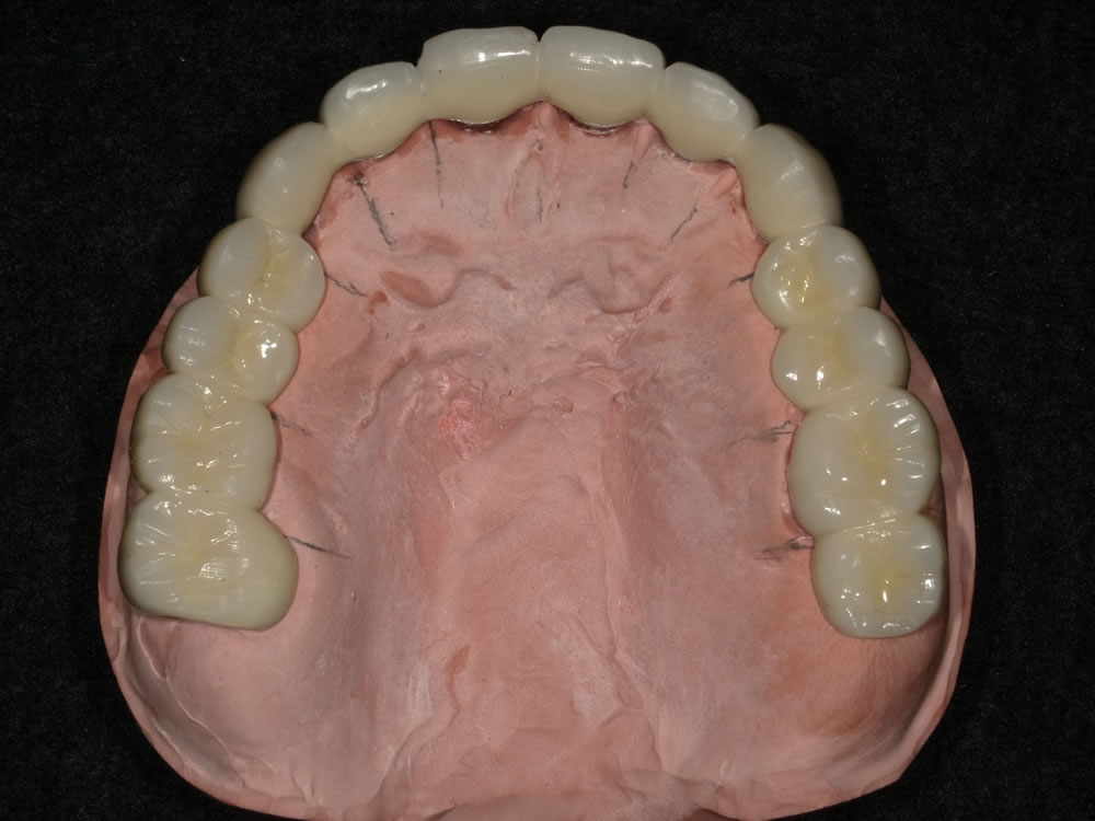 コーヌスクローネ義歯